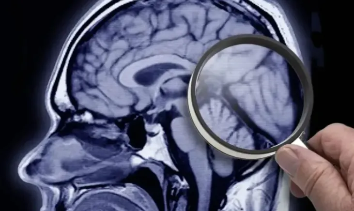 Estudo identifica proteína que acelera desenvolvimento do Alzheimer