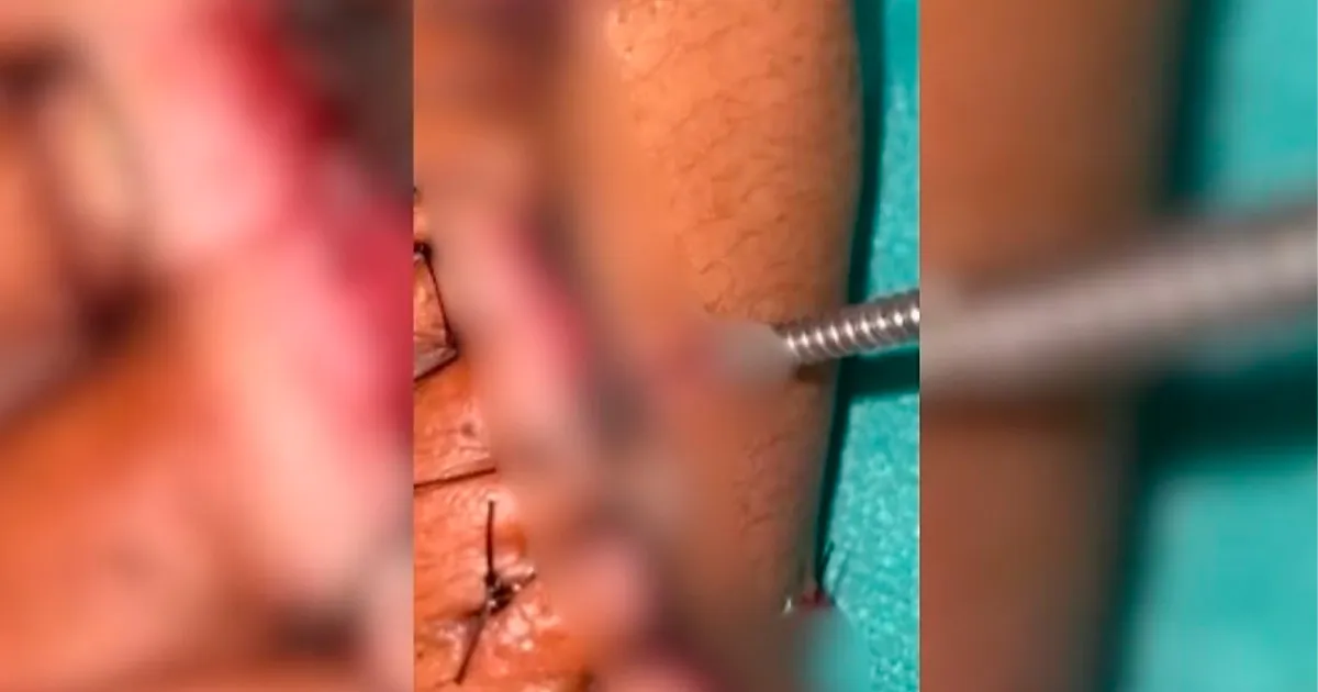 Adolescente internado encontra larvas em curativo no Pronto-Socorro de Várzea Grande